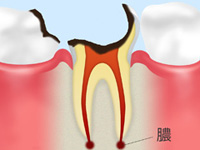 C4 【歯根まで達した虫歯】